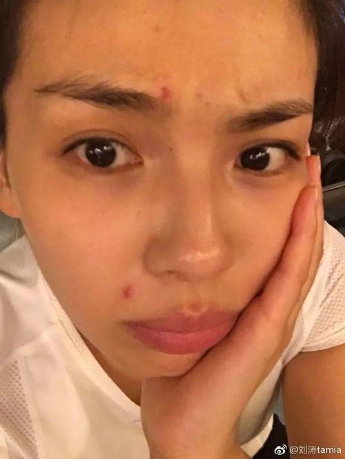 哪些明星脸上有痘痘,揭秘娱乐圈抗痘明星的护肤秘籍